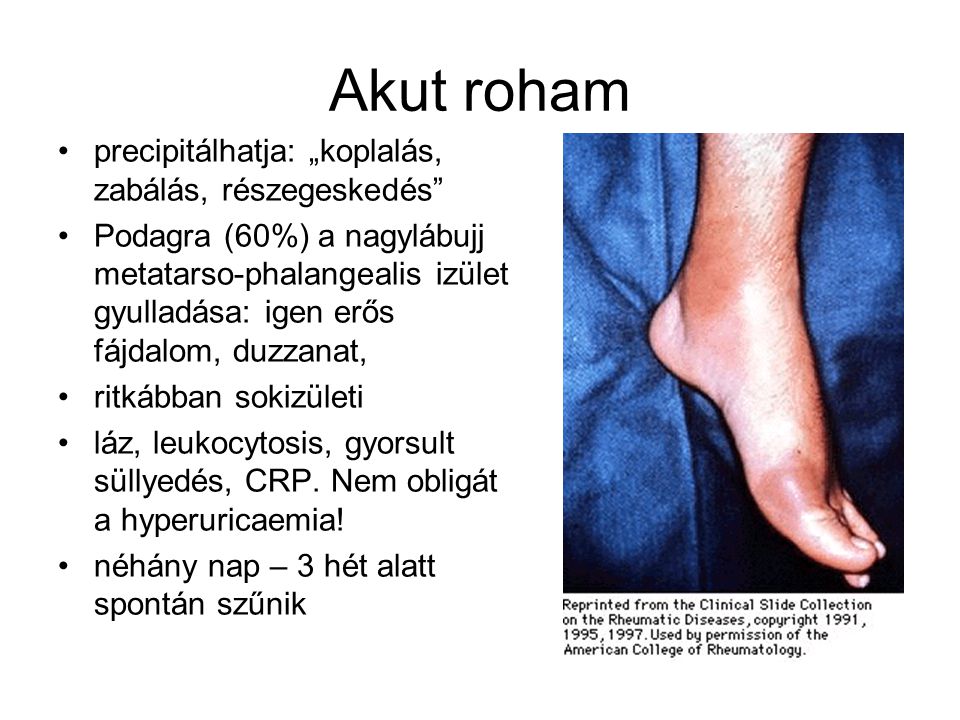 ízületi fájdalom a nagy lábujjakban karbamid az ízületek kezelésében